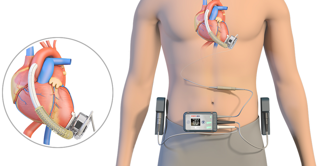 Tigermed-Jyton Accelerates Approval of China’s First Full Magnetic Suspension Artificial Heart with Professional Clinical Trial Services